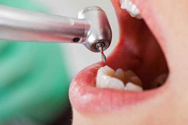 Best Broken or Cracked Tooth Emergency Dentist in Sanford, NC